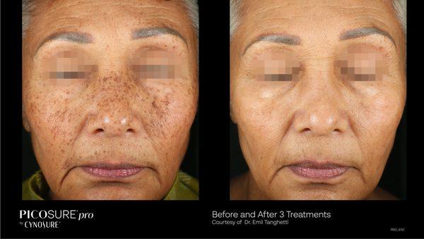 Before and after treatment of hyperpigmentation spots