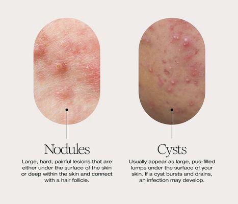 Nodules Vs Cysts