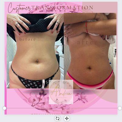 Before and after cavitation treatment