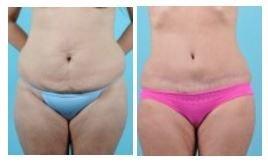 Tummy Tuck