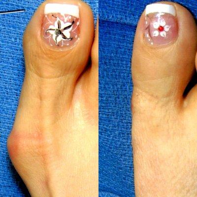 Before and After Bunion Surgery!