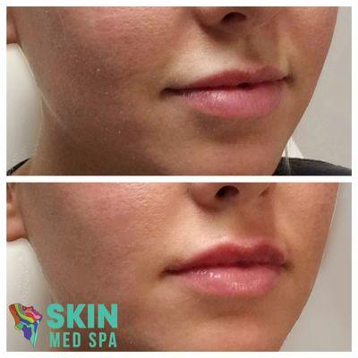 At Skin Med Spa, we deliver natural results that are specific to the client's needs. Lip filler is our most popular service!