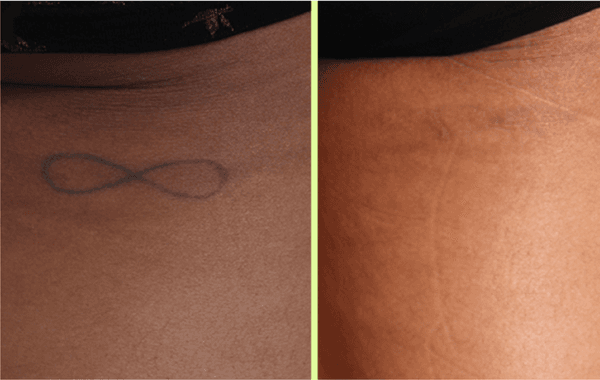 4 Picoway Candela Laser Treatments