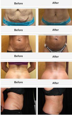 Body toning and Fat reduction