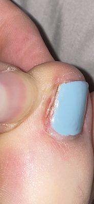 Toe nail