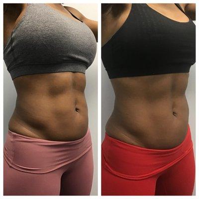 Emsculpt for Muscle Toning and Fat Reduction