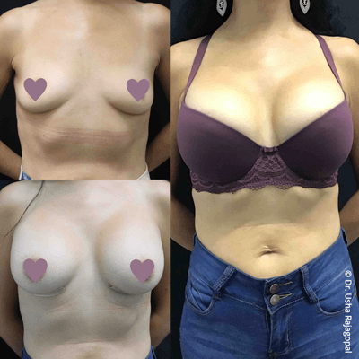 Breast Augmentation by Dr. Usha Rajagopal | San Francisco