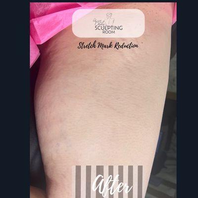 Stretch Mark Reduction, After 1 session