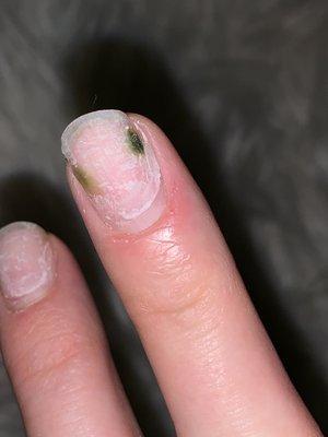 Fungal infection 2 1/2 weeks with the dips nails.