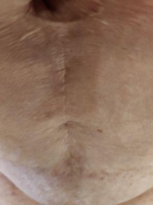 Necrotic area AFTER second tummy tuck with  correction. (Standing straight)