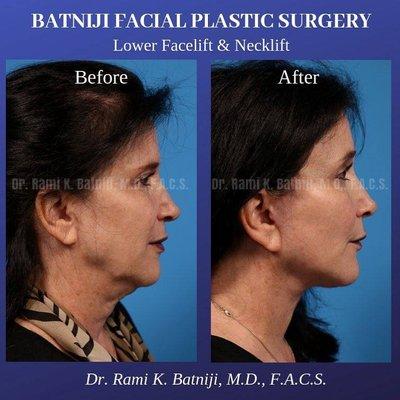 Lower facelift and necklift by Dr. Batniji