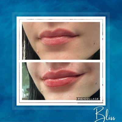 Beautiful lips is one of our specialties