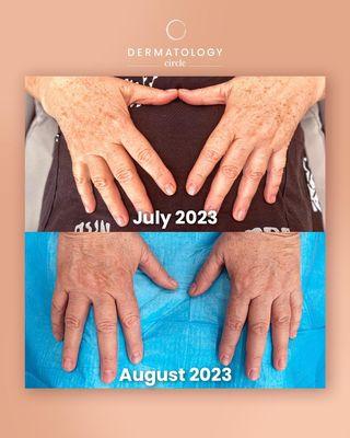 Hands pigmentation treatment with lasers