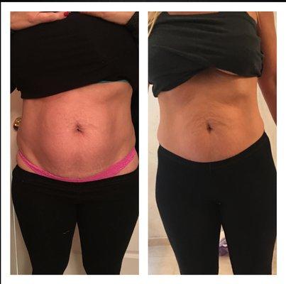 Cavi-Lipo Before and After