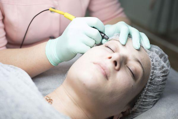 Electrolysis Hair Permanent Removal