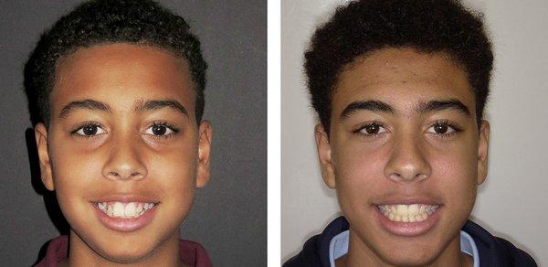 Before and After Braces Picture of Our Amazing Patient!