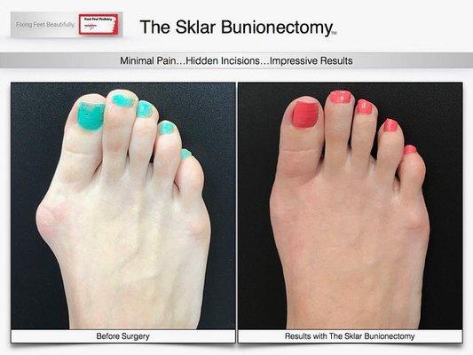 Get a super cute bunion free foot without a cast or crutches with the Sklar Bunionectomy. Visit www.footfirst.com for more information.