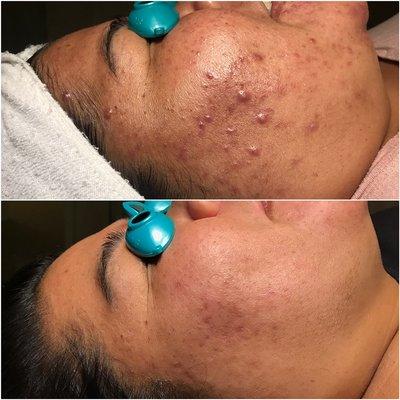 Combination acne- the acne program treats ALL acne types.