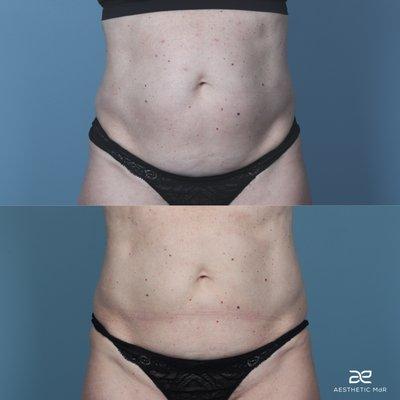 Coolsculpting Elite to the abdomen