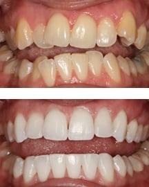 Cosmetic Dentistry Longmont