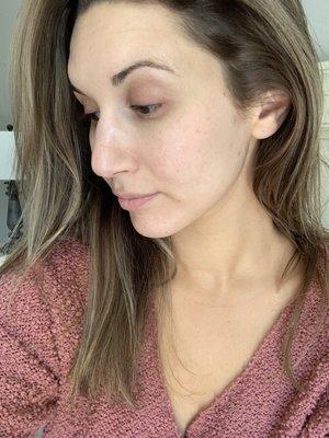 After one year of treatments and sticking to the recommended skin care routine: No makeup