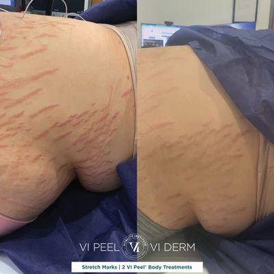 Stretch marks treatment with VI Peel Body