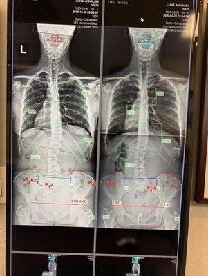 My personal before and after.