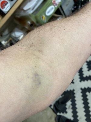 Sometimes you hit them sometimes you don't. Simple blood draw. Two days after. Heavy bruising and arm pain. Way to go :-)