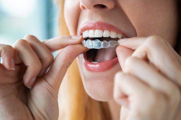 Braces can be a pain, which is why we offer clear aligners for orthodontic treatment.