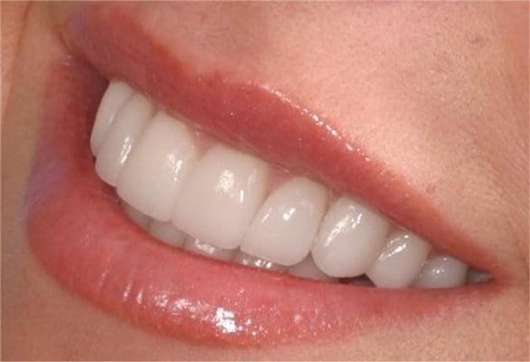 Dental Veneers are an exceptional option for those that want to put their best smile forward.