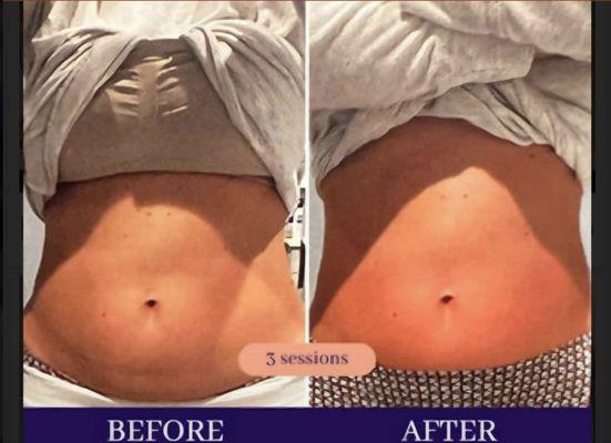 Body Contouring after 3 sesssions