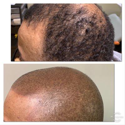 SMP - scalp pigmentation. Add density to those light area