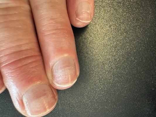 Damaged Nails