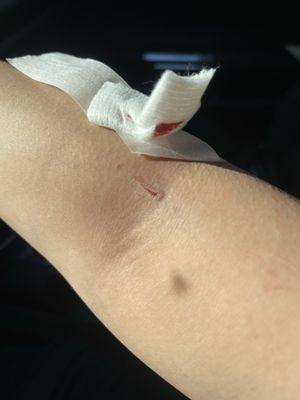 This was right after getting my blood drawn . you can clearly see a open small wound it is no small puncture.