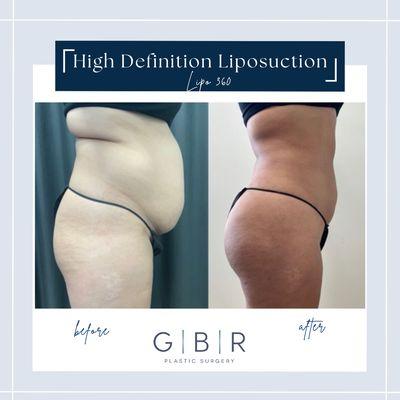 Liposuction in Virginia beach