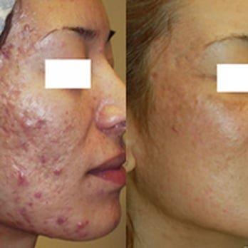 Acne Scars