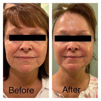 8 Point Face Lift Facial before and after photo