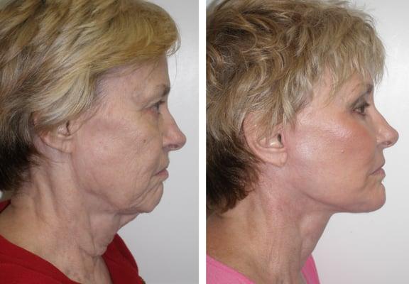 Before and after face and neck lift with cheek and chin implant and full face laser.