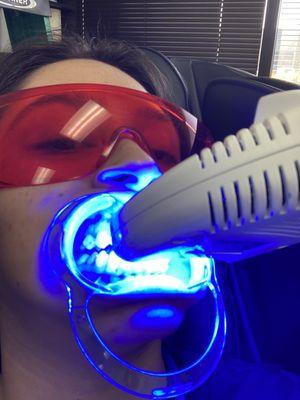 Teeth Whitening