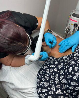 SKIN TAG REMOVALS
 Using the Fotona laser