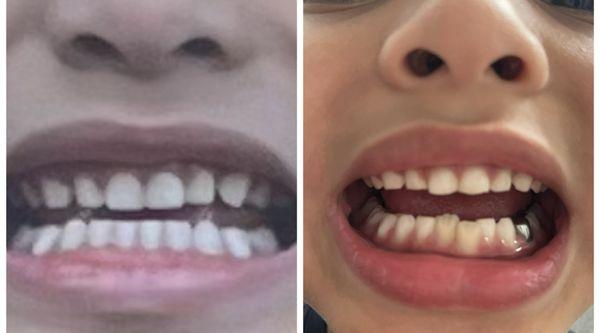 On the left: My son's mouth before his teeth grinding  The right: current, when he assumed he knew everything I gave my child