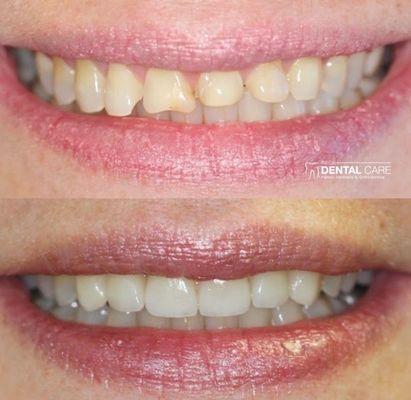 Six veneers and porcelain crowns to perfect her smile