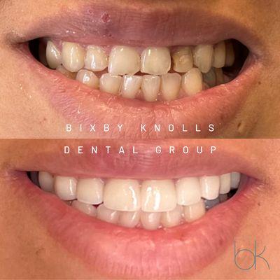 amazing before and after transformation of anterior front teeth!