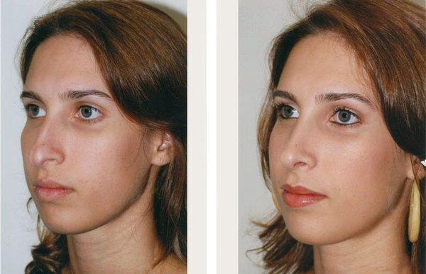 Rhinoplasty: Challenging tip and dorsum, lowered the bump, narrowed the tip and nostrils, raised the columella.