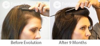 Women's Hair Loss Treatment Results in Temples