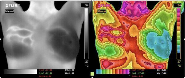 Confirmed malignancy; visible heat from the extra blood vessels feeding 3 tumors in patient's right breast.