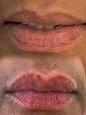 Lip dermal filler