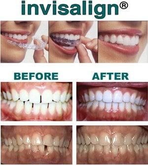 Invisalign