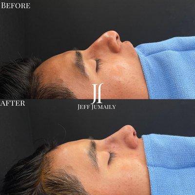 Male Primary Rhinoplasty