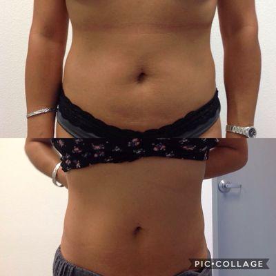 Body Contouring! Radio frequency technology!  Lipolysis and skin tightening at the same time.